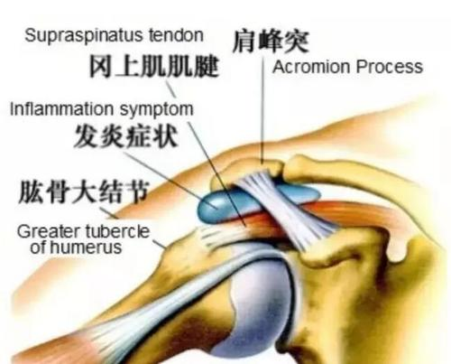 【健康科普系列二】肩周炎康复训练方法在这里