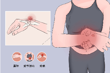 【健康科普系列二十】腕背腱鞘囊肿小知识